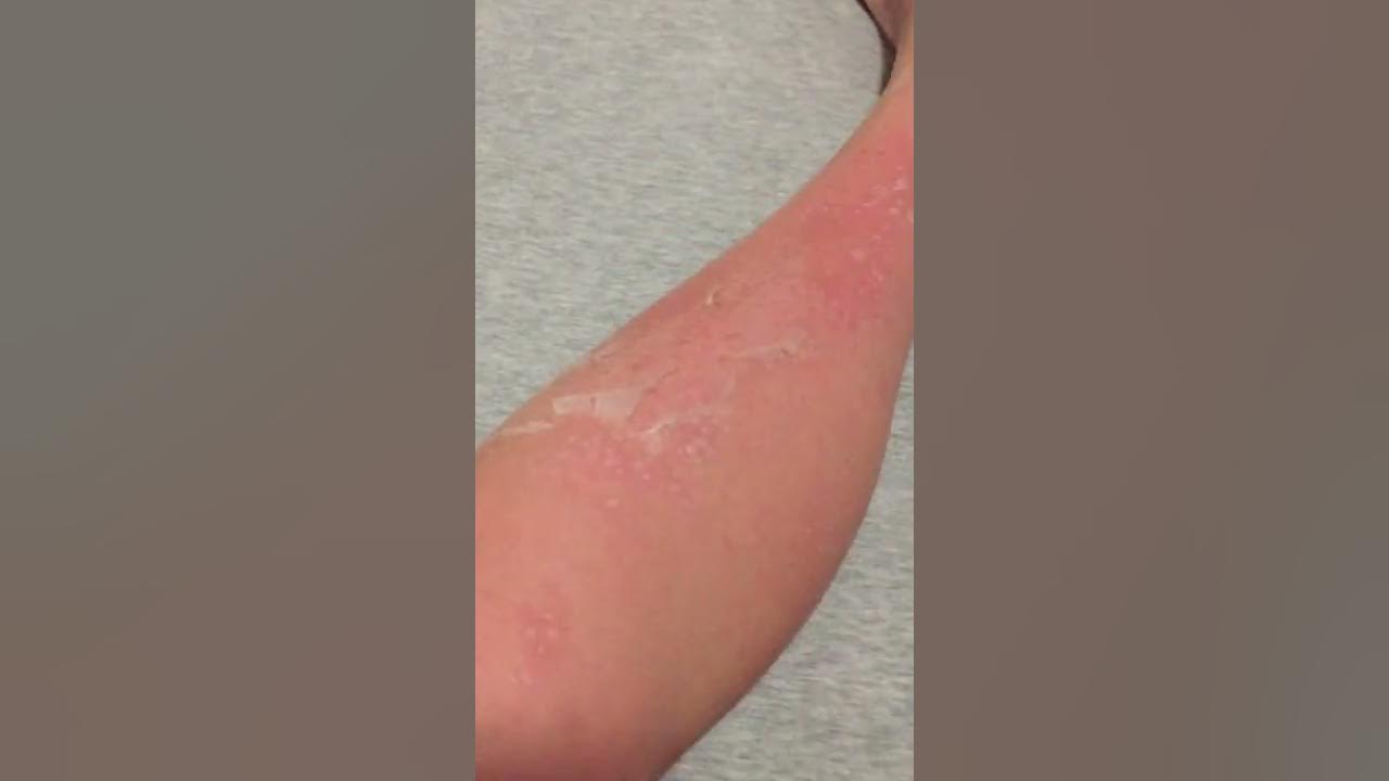 Skin Peeling from Sunburn asmr YouTube