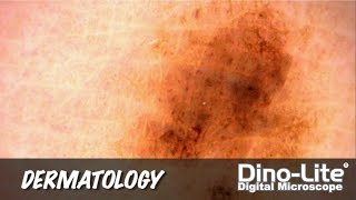 Dino-Lite Applications: Dermatology screenshot 4