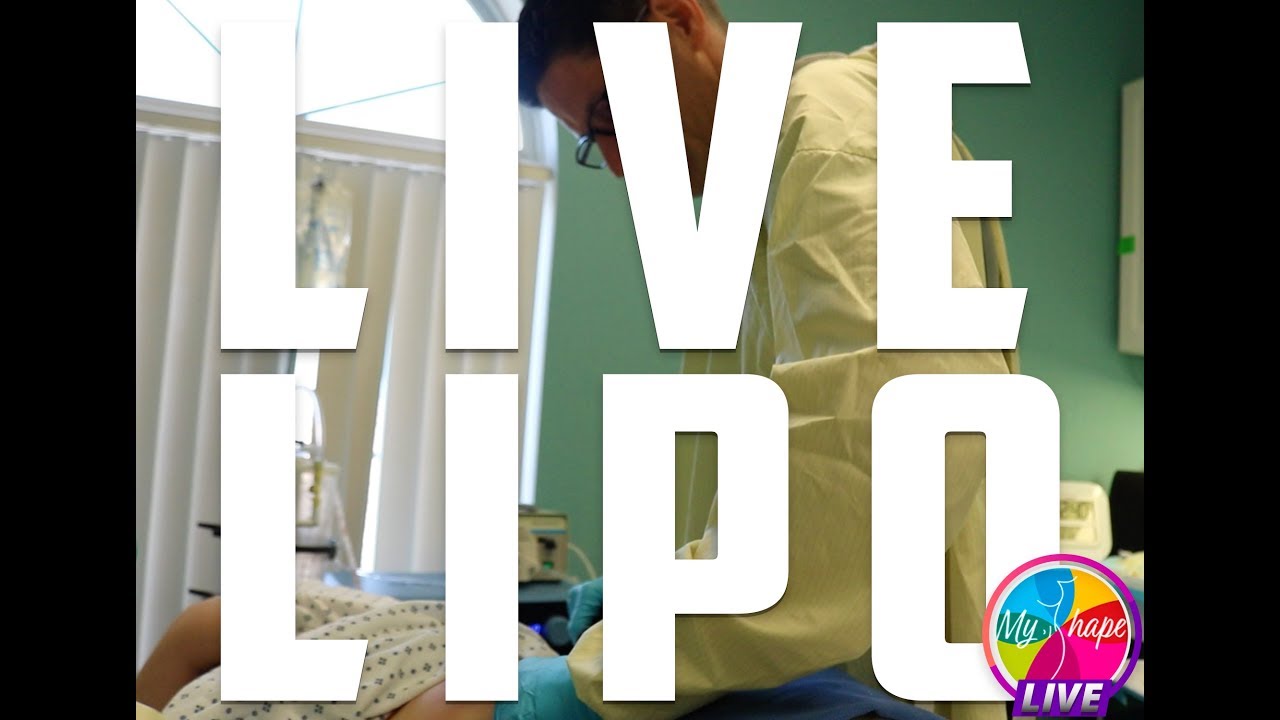 MyShape Lipo Arms Liposuction Procedure, Tumescent Liposuction