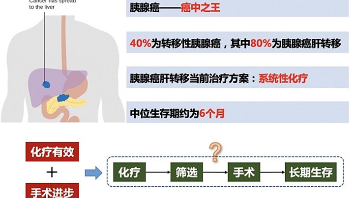 康健園｜胰腺癌肝轉移 手術一定是禁區嗎？ - 天天要聞
