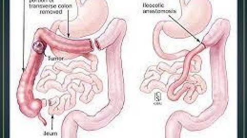 Enterectomy CPT code - simplify medical coding