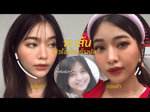 REVIEW รีวิวร้อยไหมก้างปลา 12 เส้น แก้มยก หน้าเล็กลงขึ้นมาก | mildnitha