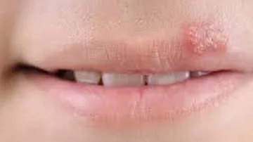 Wie lange dauert es bis eine geplatzte Lippe heilt?