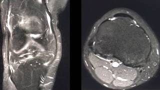 TMT: MRI KNEE LIGAMENTS