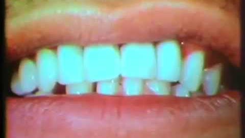 Rotational Path Concept in Removable Partial Dentures