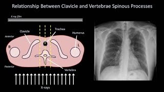 How to Interpret a Chest X-Ray (Lesson 3 - Assessing Technical Quality) screenshot 5