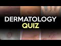 Dermatology quiz