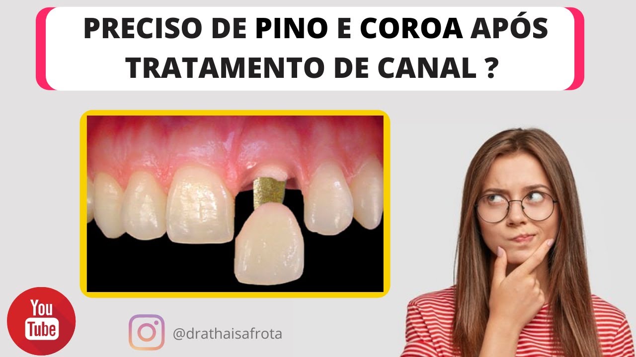Como é feito canal com pino?