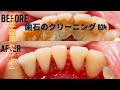 大規模な歯石の洗浄-歯石の除去 🦷 [Remove Massive Hidden Teeth Tartar] #034 DentalClinic