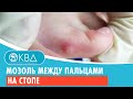 😐 Мозоль между пальцами на стопе. Клинический случай №169