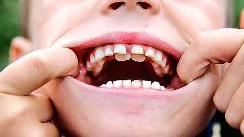¿Por qué crecen los dientes dobles?