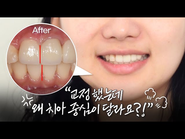 이거 아무리 봐도 교정이 잘못된 거 같은데요?? [안면비대칭교정]