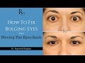 How To: Fix Bulging Eyes - Part 1 - Moving The Eyes Back