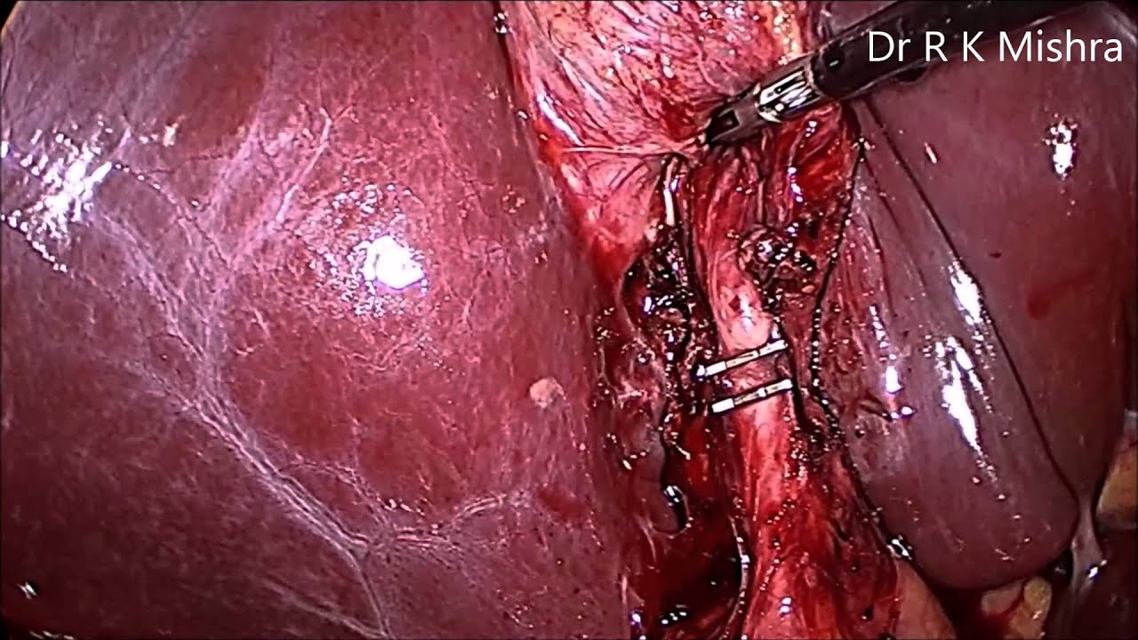 Collection of Gallbladder Removal Operation Youtube How