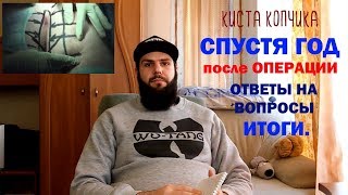 Спустя год. Киста копчика.Копчиковый ход. / Pilonidal cyst. Surgery. My story Part 2