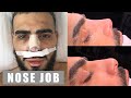 I GOT A NOSE JOB!!!!  PLASTIC SURGERY - RHINOPLASTY ISTANBUL TURKEY 2020