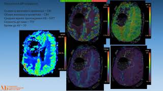 Симещенко П.И. Мультимодальный подход к диагностике рецидива глиомы в послеоперационном периоде.