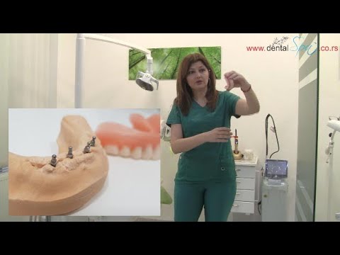 Mini implantati – Jeftino i brzo do kvalitetne totalne proteze za zube