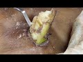 [ASMR] Sharp Ingrown Trimmed! Professional Pedicure DR LEE’S ULTIMATE ZITPOPPER 1109m2 0287