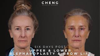 6 Days Post-Op Update | Blepharoplasty, Brow Lift &amp; Fat Transfer | Patient Journey Pt. 1