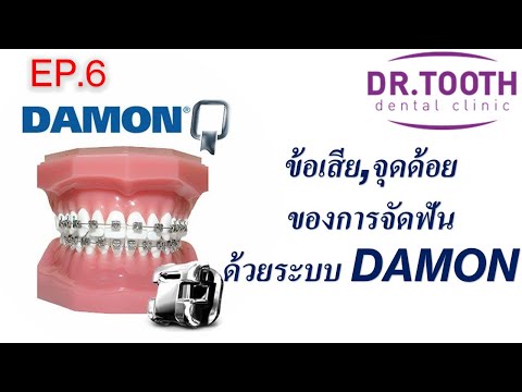 5 ข้อเสีย, จุดด้อยของการจัดฟันด้วยเดม่อน (DAMON) EP. 6