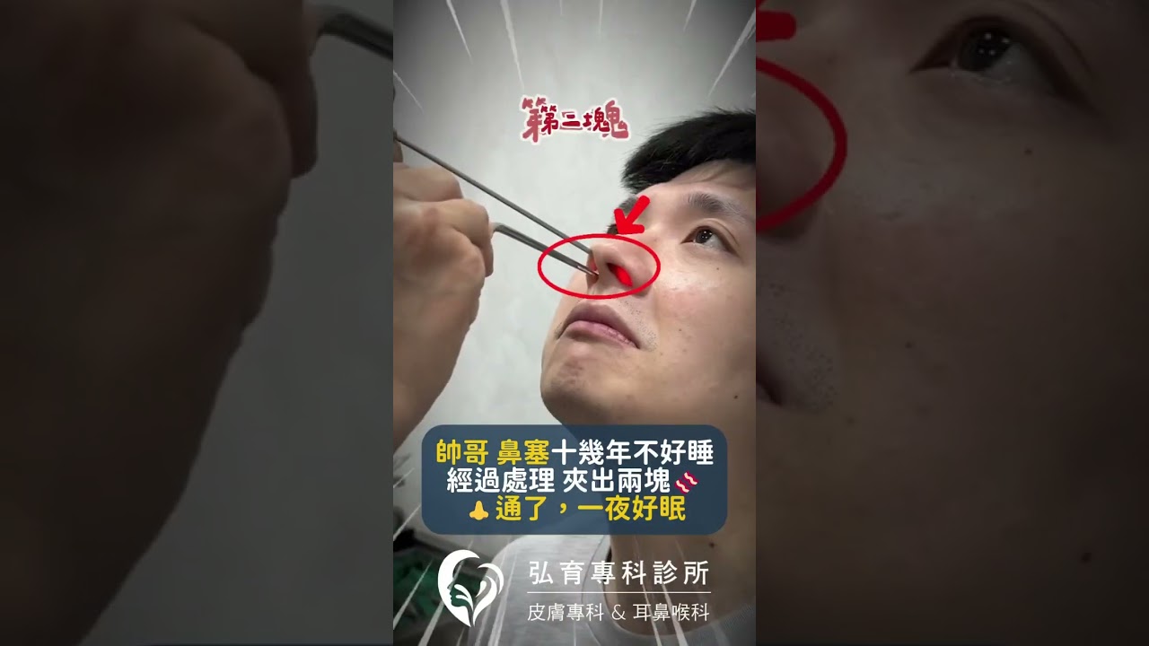 鼻子通了,睡眠也改善。#鼻塞 #鼻過敏 #微創手術 #睡眠 #弘育耳鼻喉科診所 #桃園市藝文特區 縮圖