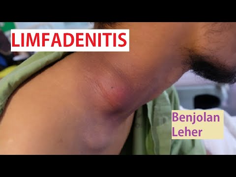 Benjolan Di Leher | Limfadenitis TB | Mycobacterium Tuberculosis | leher Membesar | Hematologi