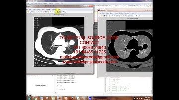 Matlab code for A Tool for Lung Nodules Analysis based on Segmentation and Morphological Operation