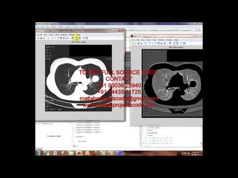 Matlab code for A Tool for Lung Nodules Analysis based on Segmentation and Morphological Operation