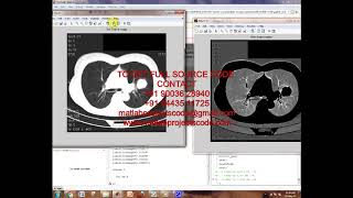 Matlab code for A Tool for Lung Nodules Analysis based on Segmentation and Morphological Operation
