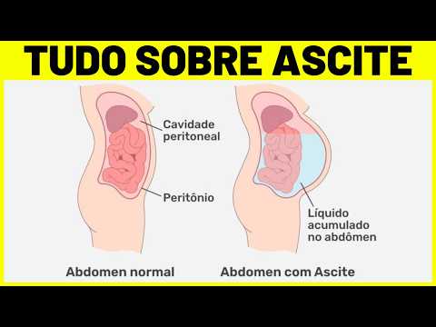 Vídeo: Ascite: Sintomas, Tratamento, Causas, Estágios, Prognóstico