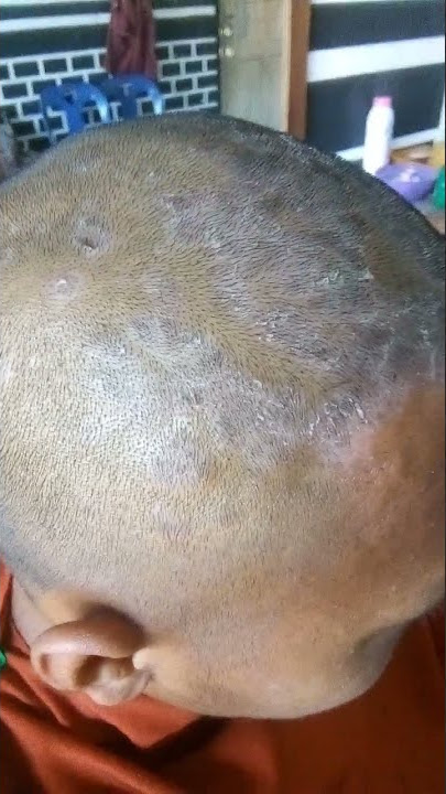 Semoga lekas sembuh‼️psoriasis - ketombe tebal, solusi penyembuh cek deskripsi.
