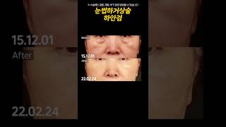 불룩한 눈 밑 살! 로렌의 눈썹하거상술과과 하안검 수술 #shorts