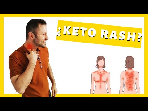 Vídeo: Keto Rash: Qué Es, Por Qué Sucede Y Cómo Curarlo