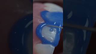 Dental motivation. Composite veneers. Direct composite restoration teeth. #dentistry #dental