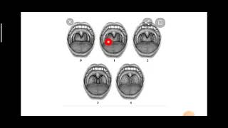Grades of Tonsillar Enlargement