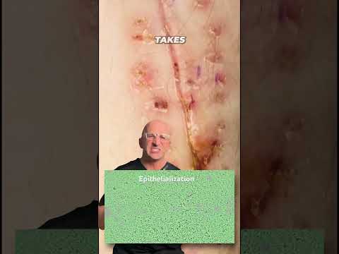 Do Covered Incisions Heal Faster Shorts