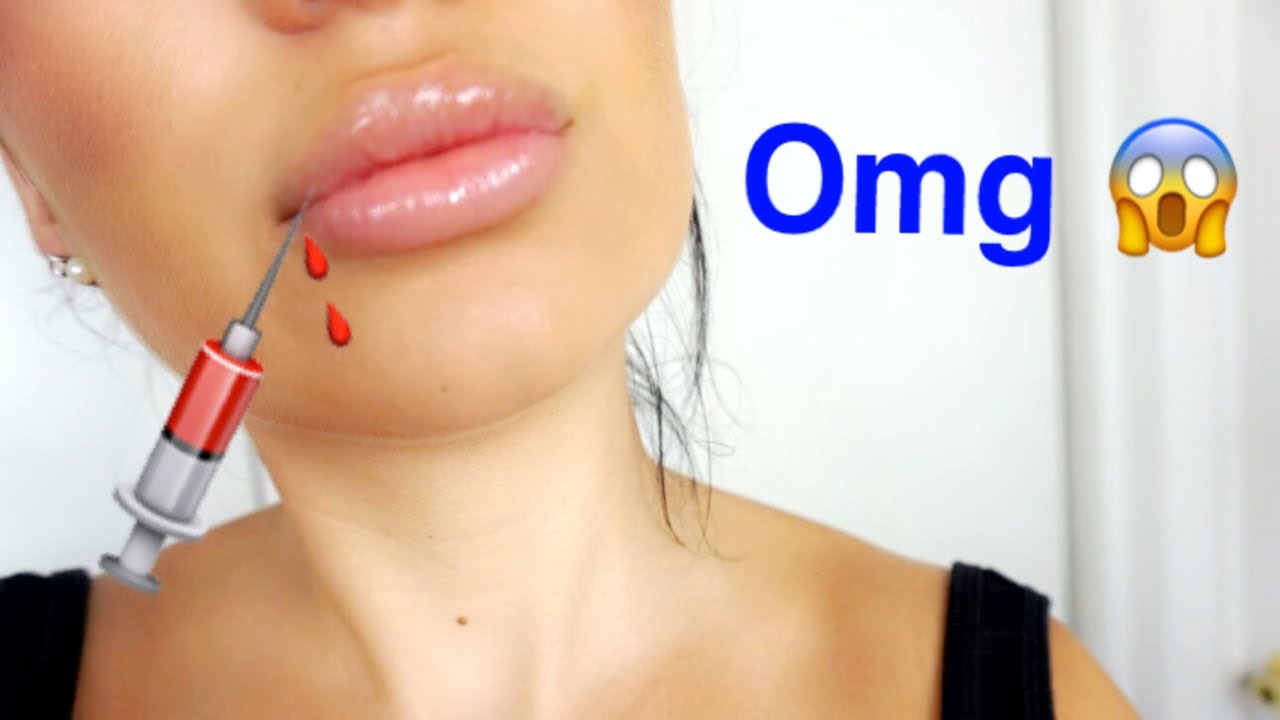 I HAVE BOTCHED LIPS! GETTING MY INJECTIONS DISSOLVED!!! - YouTube