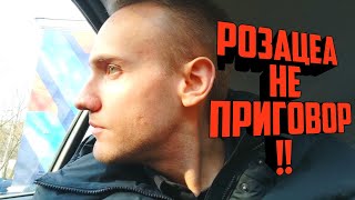 Как ВЫЛЕЧИТЬ РОЗАЦЕА Как ИЗБАВИТЬСЯ от ПРЫЩЕЙ на лице Розацеа на лице Прыщи на лице Розовые угри