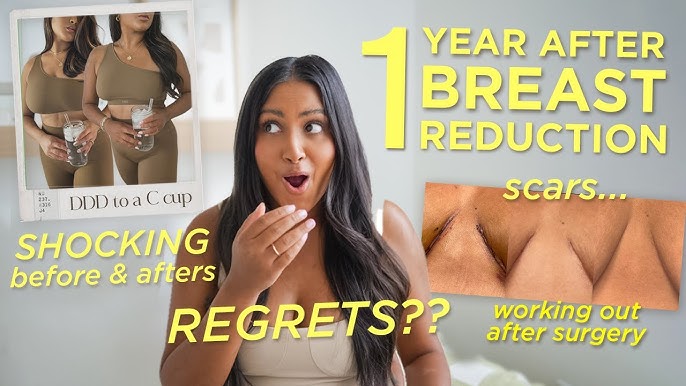 Breast Reduction & Lift Recovery Vlog + RESULTS, DDD to C Cup