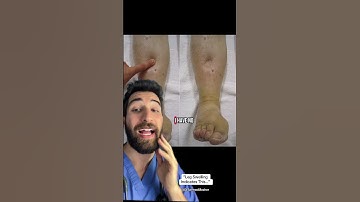 “Swelling of the Legs Means This…” #what