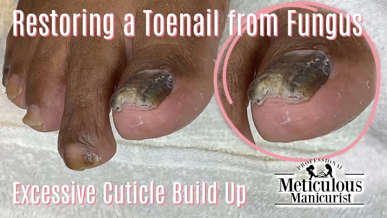 👣How To Pedicure A Toenail Fungus - Restoration Process👣