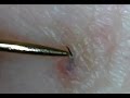 Ingrown Hair 埋没毛の救出!PART5