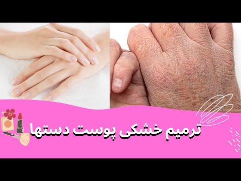 تصویری: 3 راه برای از بین بردن خشکی پوست روی پاها