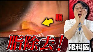 ドライアイの人、この脂に気をつけて！目のフチの脂を除去してドライアイ即解消！【写真症例あり】