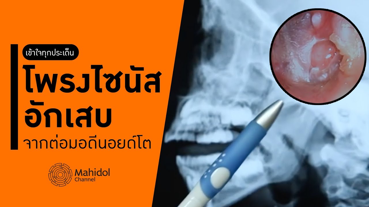 โพรงไซนัสอักเสบจากต่อมอดีนอยด์โต [หาหมอ by Mahidol Channel]