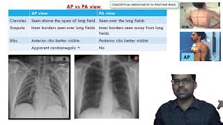 PA VIEW Vs AP VIEW- CHEST X RAY