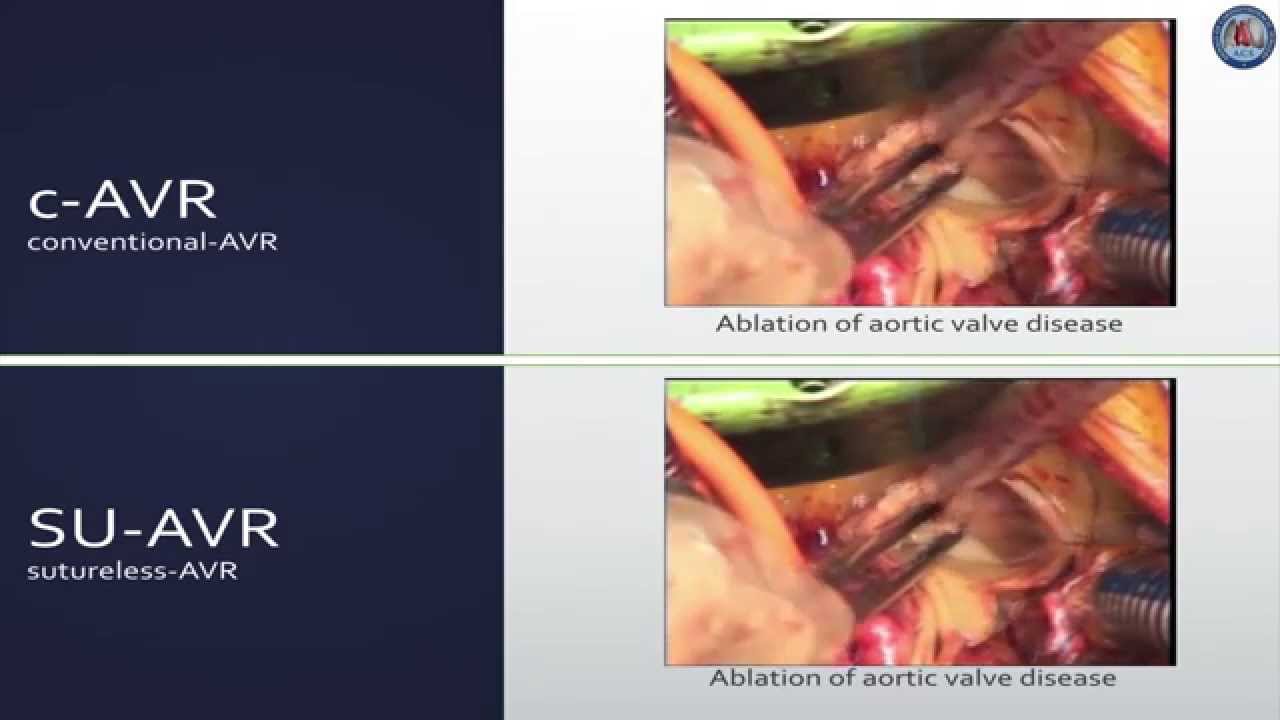 [Keynote Lecture] Sutureless aortic valve replacement - YouTube