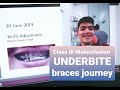 Underbite (Class III Malocclusion) Braces Journey Update | August 2018–Present | Philippines