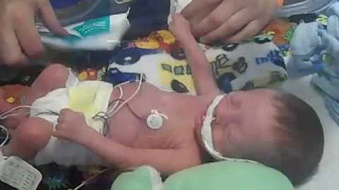Grady 5 weeks old NICU 7/8/10